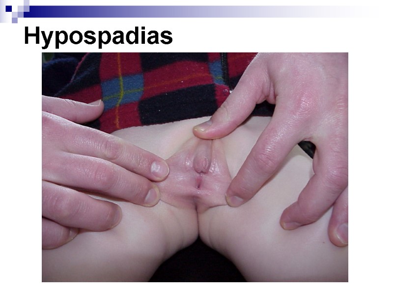 Hypospadias